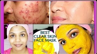 Best Acne Treatment | How to Get Flawless Skin | Skin Care Routine | SuperPrincessjo