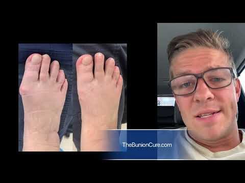 Discussing Lapidus vs minimally invasive bunion procedure (Bosch/SERI bunionectomy)