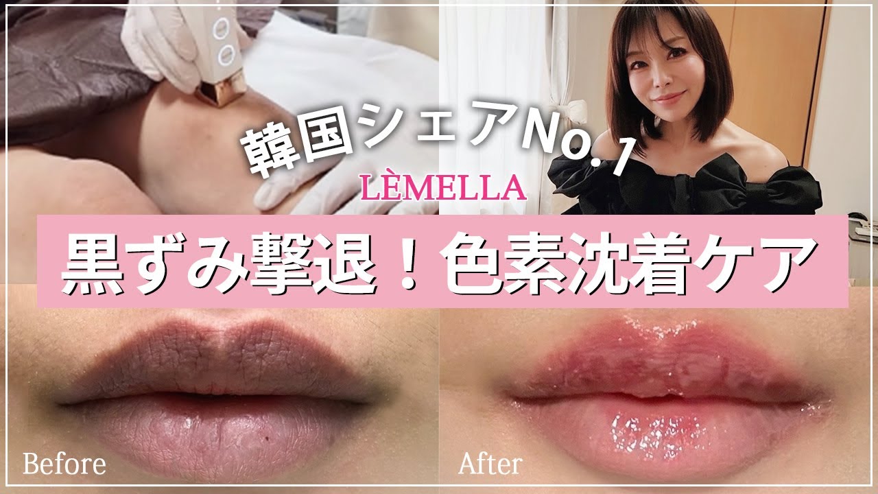 韓国発♡最先端美容《ルメラ》で黒ずみ・色素沈着を解消！！－視聴者様割引特典＝