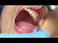Surgical Tooth Extraction [WARNING] Extreme Decay Beneath Crown
