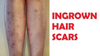 how to get rid of ingrown hair scars on legs