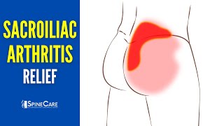 How to Instantly Relieve Arthritic Sacroiliac Joint Pain