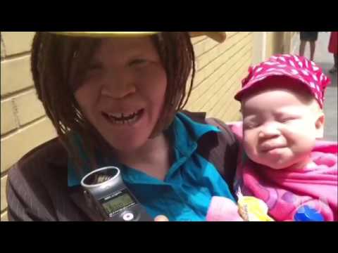 Vanorarama Nehusope Vowana Rubatsiro Kubva KuCBZ ne Albinism Alive Initiative