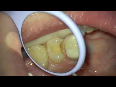 Class II Cavity Preparation Upper Second Premolar / Caries Removal Under Microscioe