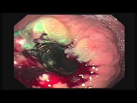 Endoscopic Reversal and Bypass of Strictured Vertical Banded Gastroplasty