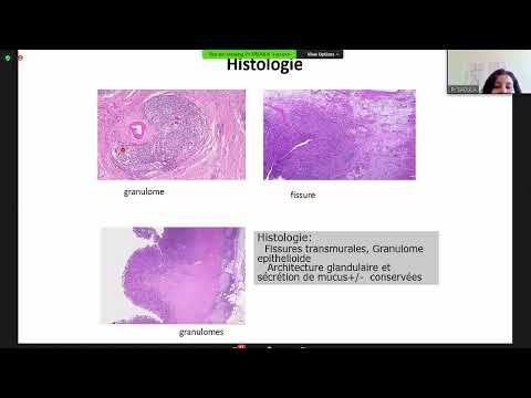 MICI -  Maladie de Crohn Pr Saoula - Cours officiel de la faculté de médecine d'Alger