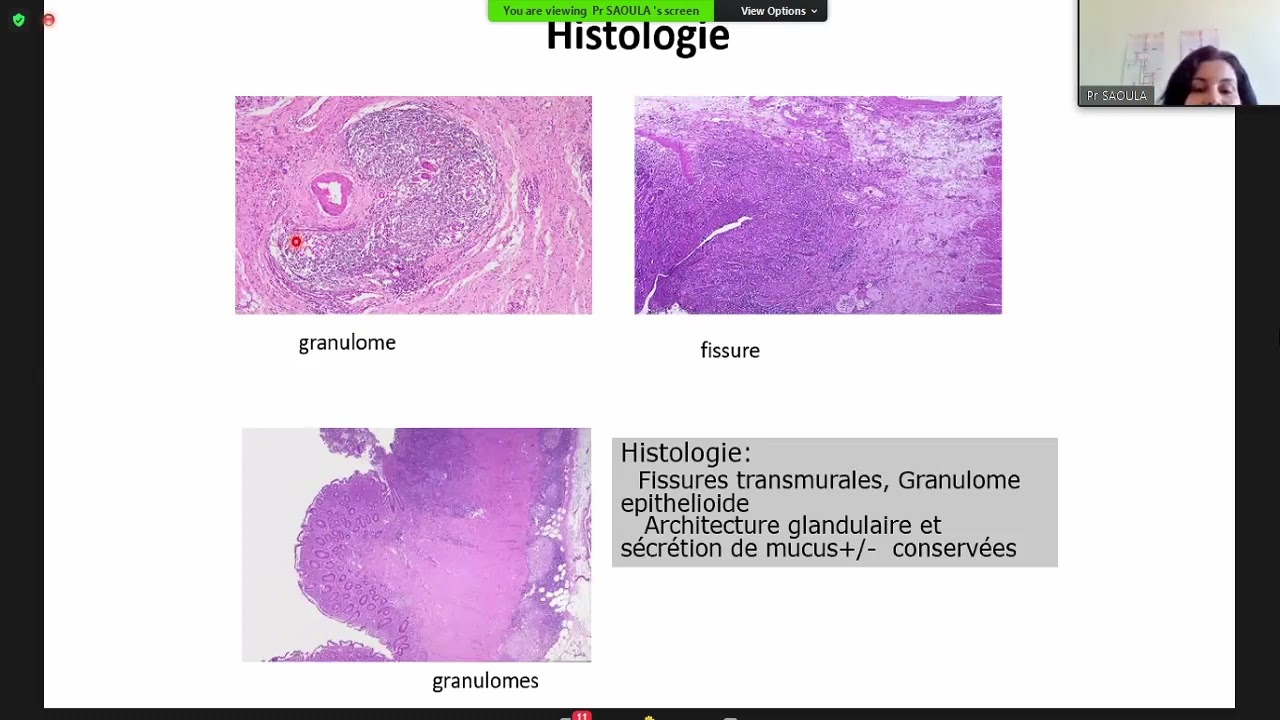 MICI -  Maladie de Crohn Pr Saoula - Cours officiel de la faculté de médecine d'Alger