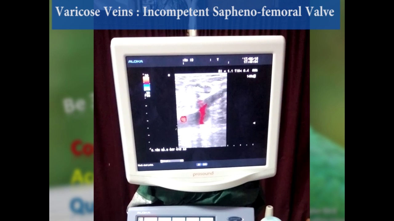 Incompetent Sapheno-femoral Valve