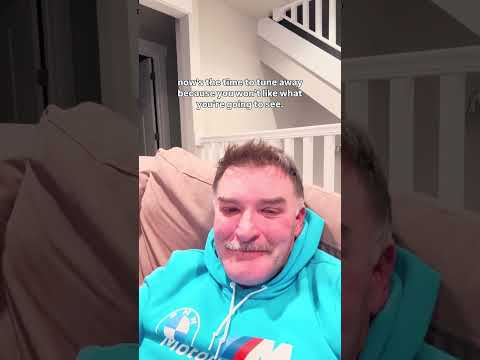 Rhinoplasty Complex Reconstruction. WardMD Rhinoplasty.