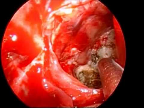 Epidermoid In Petrous Apex 