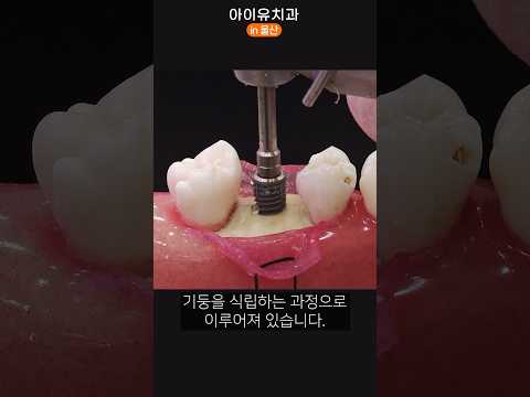 임플란트 치료 유튜브