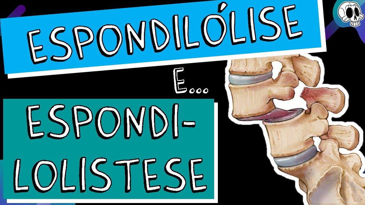 Espondilólise | Espondilolistese | Espondiloptose