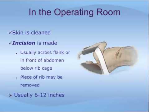 Partial Nephrectomy - YouTube