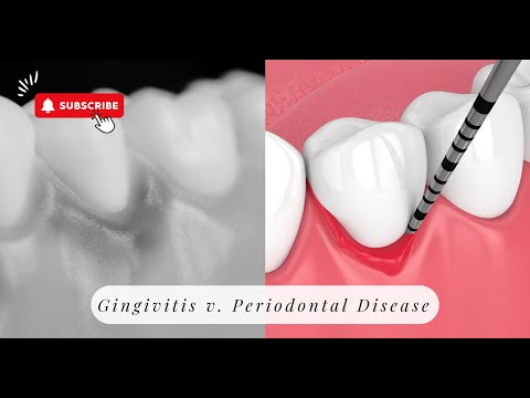 Understanding Gingivitis vs. Periodontal Disease: What You Need to Know 🦷