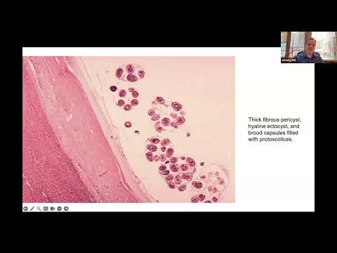 Managing Hydatid Disease without a Surgeon - Jeremy Nel