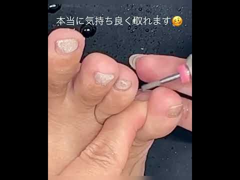 指周りのハードスキン除去に