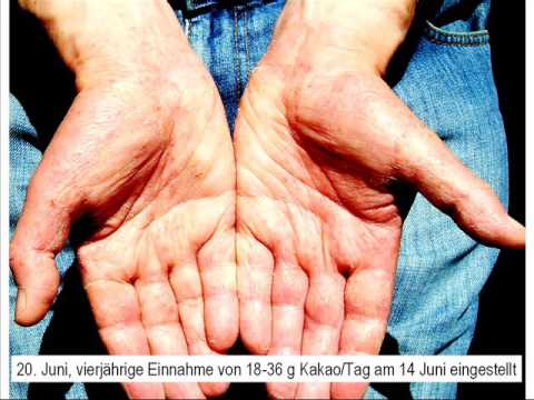 Welche man das Shampoo bei der Schuppenflechte verwenden kann Das Ekzem der Gehördurchgänge, wie zu behandeln