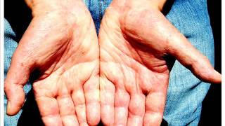 Orale Nickelallergie Symptome Nur Auf Der Haut Oder Auch Im Verdauungstrakt Ernahrung Lebensmittel Allergie