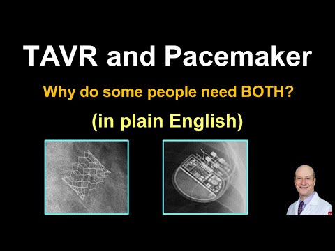 TAVR and Pacemaker - May I Need Both? (In Plain English)