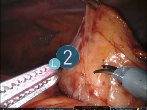 Right Robotic Partial Nephrectomy