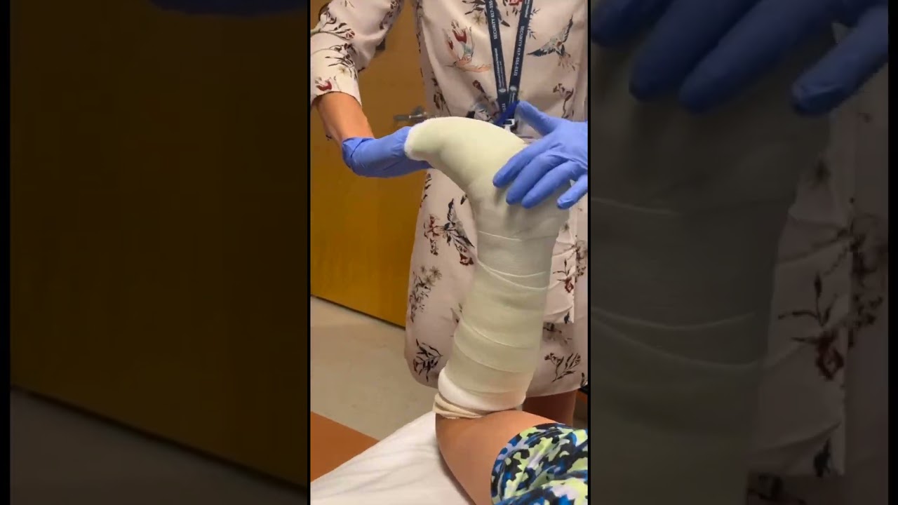 How to apply a short leg cast | Boston Children's Hospital #cast #shorts