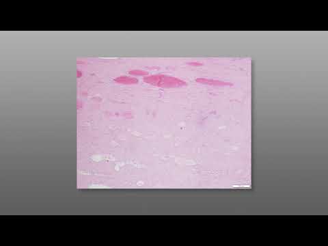 Fine Needle Aspiration Biopsy (FNA) Techniques - Sampling Highly Vascular Targets