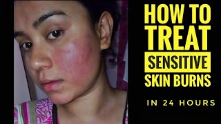 My SENSITIVE  SKIN BURNS & ALLERGIES  Live Treatment  Sensitive skin home remedies | Lovebeautybee