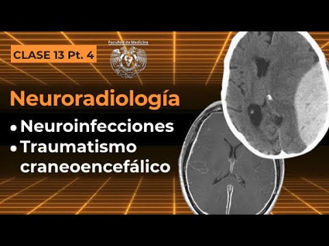 13.4 -  Neuroradiología: Neuroinfecciones y Traumatismo Craneoencefálico