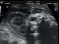 ENCEFALOCELE FRONTAL VIDEO INEDITO