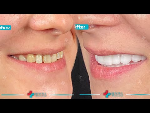 Dental Treatment adn cosmetic surgery in Turkey | The experience of Ms. Rosq from ispane