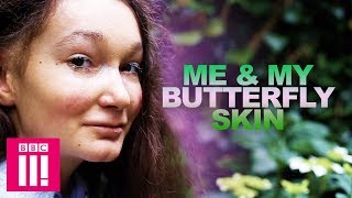 Me &amp; My Butterfly Skin | Living Differently