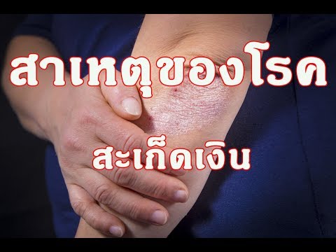 โลชั่น Diprosalik และโรคสะเก็ดเงิน ครีม Panthenol กลาก