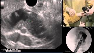 AXIOS BD drainage  A step by step tutorial SD