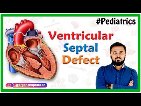 Ventricular Septal Defect : Etiology, Pathophysiology, Clinical features, Diagnostics, Treatment