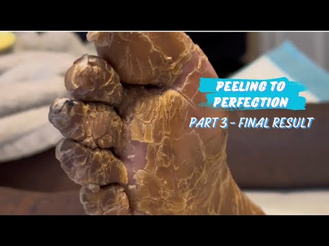 PEELING TO PERFECTION [PART 3] | MEDICAL PEDICURE