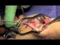 Thumb CMC Arthroplasty with FCR LRTI