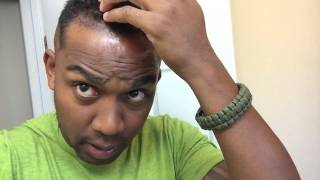 FUE Hair Transplant Bosley Beverly Hills: Post Op day 1