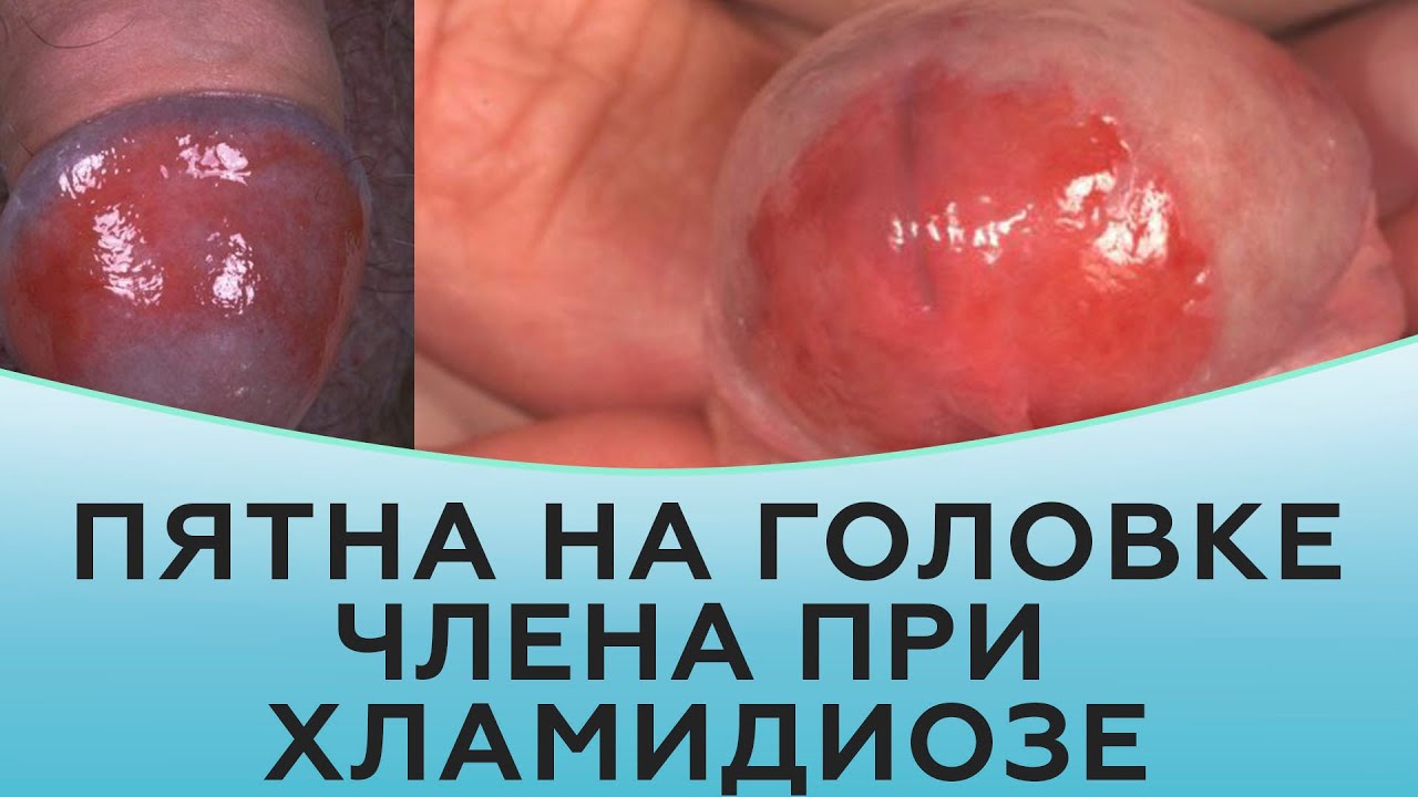 Пятна на головке члена при хламидиозе