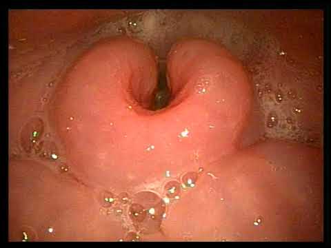 Pre bronchoscopy endoscopic exam in a patient after radiation therapy from AOD pt1425