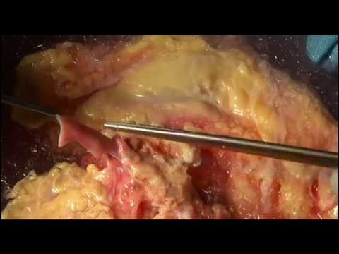Cadaver donor organ procurement and Transplantation