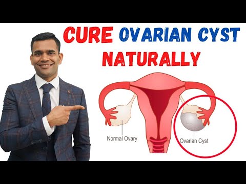 Just 3 Recommendations To Cure Ovarian Cyst Naturally - Dr. Vivek Joshi