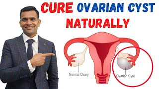 Just 3 Recommendations To Cure Ovarian Cyst Naturally - Dr. Vivek Joshi