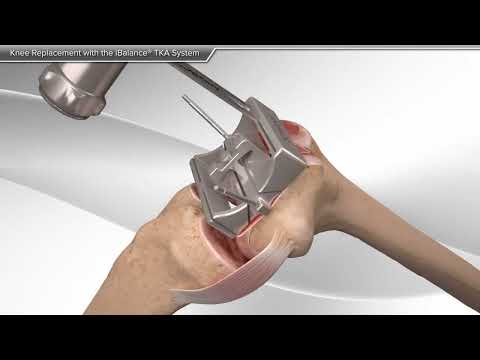 Total knee replacement - 3D animation with explanation