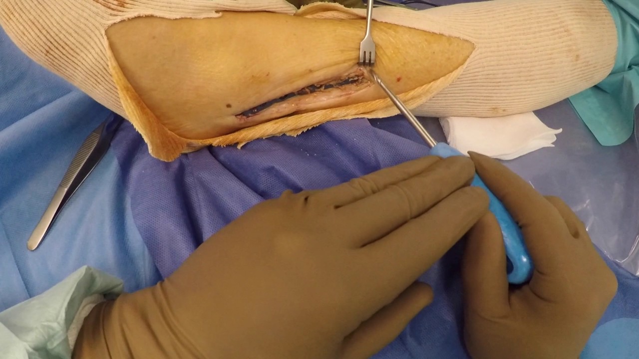 Watch Now RIMOZIONE MEZZI DI SINTESI (PLACCA PERONE) -DOTT. JACOPO CONTEDUCA RIMOZIONE MEZZI DI SINTESI (PLACCA PERONE) -DOTT. JACOPO CONTEDUCA