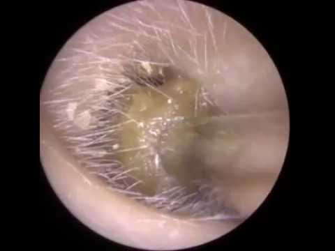 Ear wax removal by microsuction