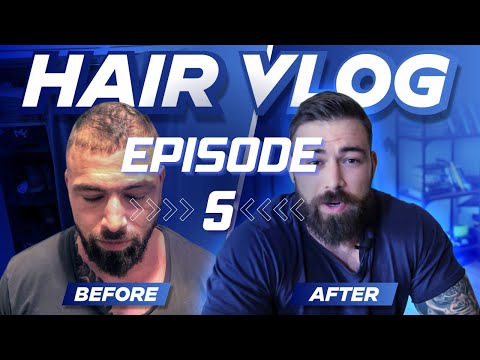 Hair loss treatment vlog #5 - My 2023 hairloss reversal nuke stack - Pyrilutamide, finasteride etc.