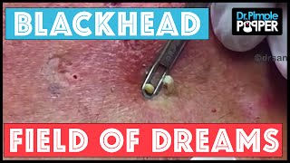 Blackhead Field of Dreams: Supercomedones & Dilated Pores of Winer