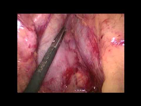 Laparoscopic Total Colectomy With Trans-Anal Extraction