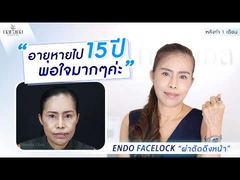 ล็อคผิวให้ตึง ดึงหน้าลดริ้วรอย ผ่าตัดดึงหน้า ที่ นารดาคลินิก