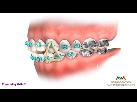 How to Wear Rubber Bands - Vertical or Triangle Upper 3 Lower 3, 4